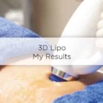 3d-lipo-ireland-results-before-after